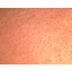 What’s That Rash? How to ID 14 of the Most Common Skin Irritations