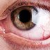 9 Reasons You Have Bloodshot Eyes—and How to Fix Them