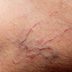 10 Ways to Erase Broken Capillaries—and Prevent Them Completely