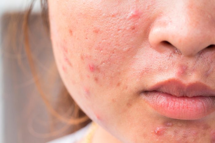 Combination acne scars on a woman's skin.