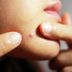 Why You Get Chin Acne—and How to Clear It Up