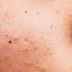 There's a New Way to Remove Blackheads—and Beauty Pros Can't Stop Talking About It