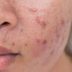 Here’s What Your Acne Breakout Is Actually Telling You
