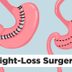 The Top Weight-Loss Surgery Procedures—Ranked and Demystified